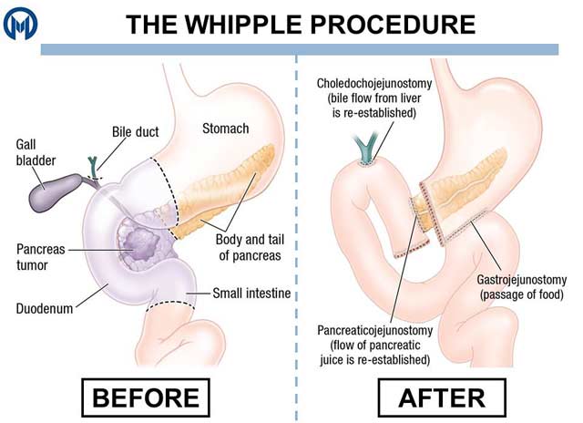 whipple-procedure